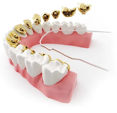 Поставить брекеты в Минске, цена: Сколько стоит установка брекет-системы в  рассрочку