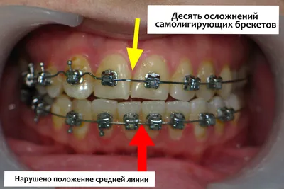 Вестибулярные и лингвальные брекеты — цена установки в Челябинске