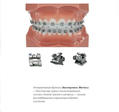 Металлические брекеты цены на услуги, виды систем, установка в  стоматологической клинике GMS DENTAL на Смоленской