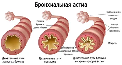 Бронхиальная астма: диагностика и лечение