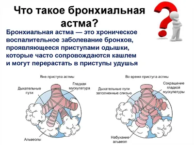 О профилактике бронхиальной астмы - Статьи - Новости, объявления, статьи -  Официальный сайт Асбестовского городского округа