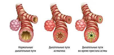 Бронхиальная астма: симптомы, причины, диагностика и лечение в лучших  клиниках - MedTour