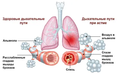 Бронхиальная астма понятным языком. Частые вопросы от коллег и пациентов. |  Аллергология и Иммунология