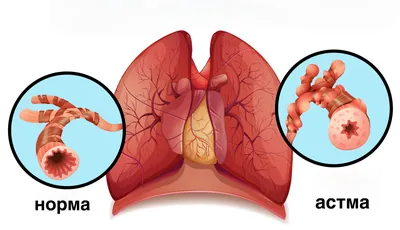 Бронхиальная астма » Библиотека врача