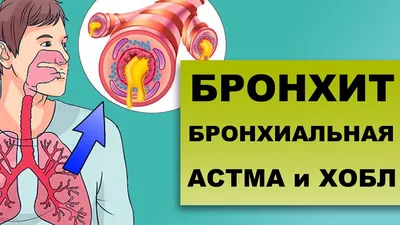 Бронхиальная астма у детей - как понять что у ребенка бронхиальная астма