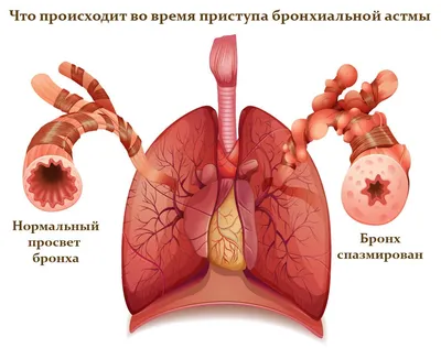 Новости - Бронхиальная астма: что делать?