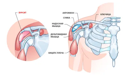 Бурсит: коленного сустава, локтя, стопы, плеча, лечение