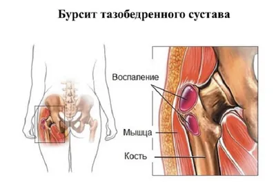 Бурсит плечевого сустава: симптомы, причины. лечение в Москве