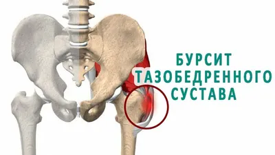 Бурсит плечевого сустава у взрослых: причины, симптомы, лечение,  профилактика в домашних условиях