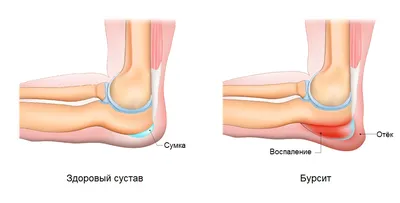 Бурсит локтевого сустава: причины, симптомы, лечение в Москве