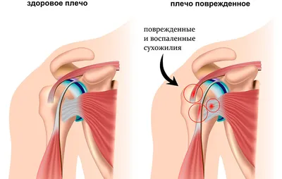 Лечение бурсита локтевого сустава #больвсуставах #больвлокте #бурсит  #zdravclinic - YouTube