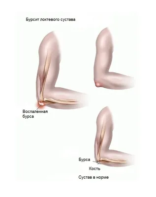Бурсит сустава - лечение и симптомы, причины заболевания, какой врач лечит