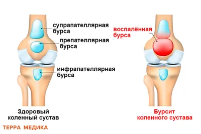 Бурсит сустава: лечение, симптомы, причины и показания к операции