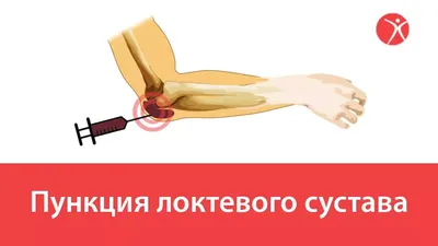 Бурсит ахиллова сухожилия - признаки, причины, симптомы, лечение и  профилактика - iDoctor.kz