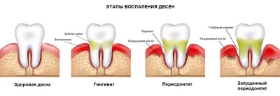 Гингивит: лечение у детей и взрослых — Хирургическая Стоматология