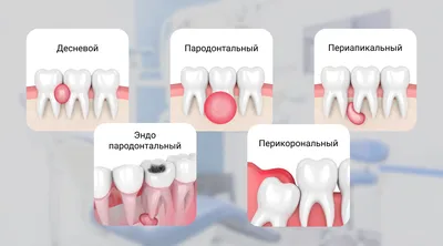 Лечение десен у детей в Смоленске - стоматит, гингивит, периостит и  пародонтит, цены и процедуры