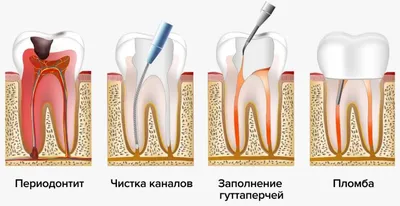 Почему возникает свищ на десне и как его лечить – полезная информация,  стоматология ЛидерСтом в Москве