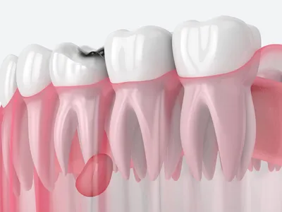 Лечение флюса на десне (периостита зуба) по цене от 1950 руб в Москве