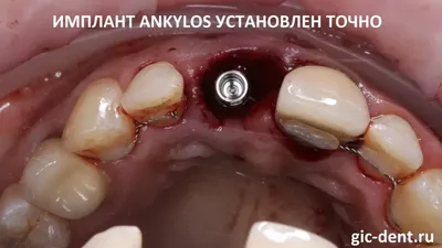 Нужно ли лечить свищ на десне и как от него избавиться