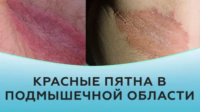 Почему растет родинка? Что делать, если растет родинка?