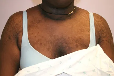 Acanthosis nigricans