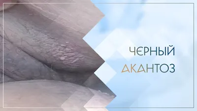 Черный акантоз (фото): как лечится, какой прогноз? | Plastichno | Дзен