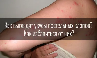 Прыщи на голове в волосах: причины и лечение | Блог IHC Clinic