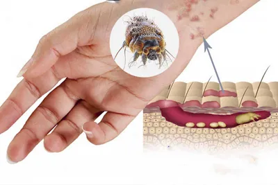 Чесотка лечение консультация в Санкт-Петербурге в медицинском центре  ID-CLINIC