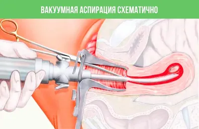 Вакуумная аспирация (чистка матки) при замершей беременности на раннем сроке