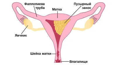 Замершая беременность: признаки, симптомы, причины на раннем сроке  беременности