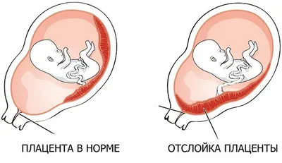 Вакуумный аборт: что это, как и на каких сроках делают мини-аборт, сколько  стоит, можно ли после него забеременеть