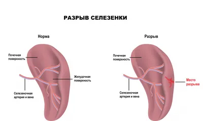 Боль и тяжесть в левом подреберье - причины появления, при каких  заболеваниях возникает, диагностика и способы лечения