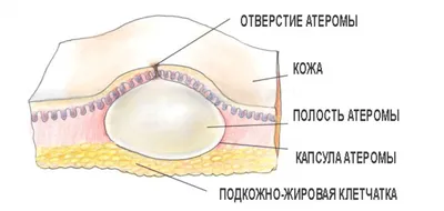 Атерома. #атерома #эпидермальная киста #себорейная киста | Врач-онколог  Чачух Азамат Заурович | Дзен