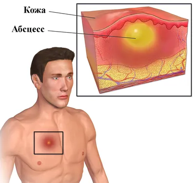 Удаление атеромы Киев | Позняки | Осокорки | Демеевская