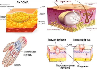 Удаление липом (жировиков), атером и фибром на лице и теле в клинике  лазерной хирургии «Вектор»