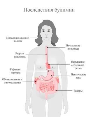 Что такое булимия картинки