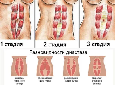 Диастаз прямых мышц