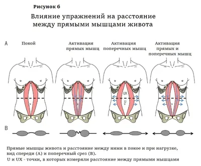 Диастаз в послеродовом периоде: операция или спорт?