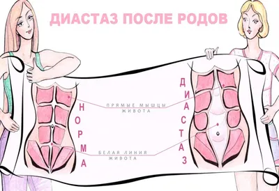 Диастаза живота. Что делать для его устранения? - Исамутдинова Г. М.