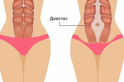 Диастаз в послеродовом периоде: операция или спорт?