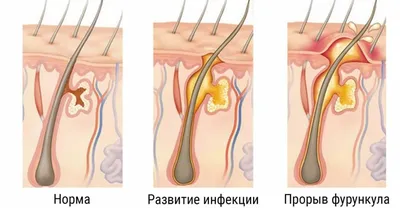 Лечение фурункула