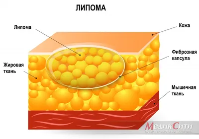 Липома (жировая опухоль, жировик)