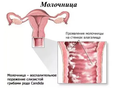 Молочница во рту у ребенка и взрослого: 8 характерных симптомов,  комплексная терапия и профилактика