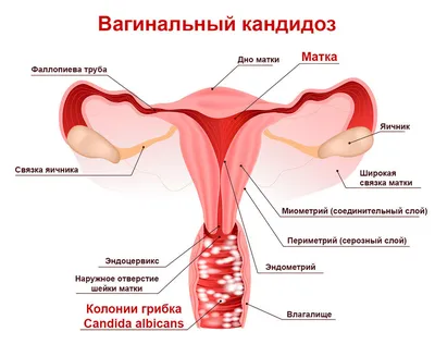 Почему мы не можем вылечить кандидоз - Постоянная молочница: причины и  лечение