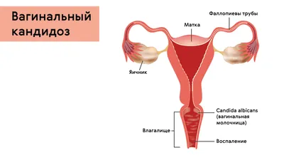 5 главных заблуждений о молочнице - Семейная консультация