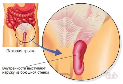 Можно вылечить паховую грыжу без операции