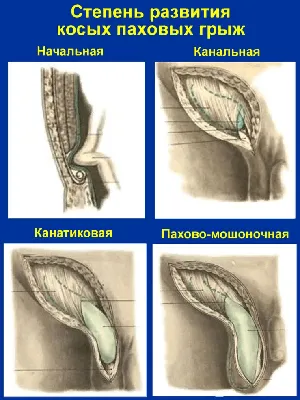 Лечение паховой грыжи, стоимость в Казани Майя Клиник