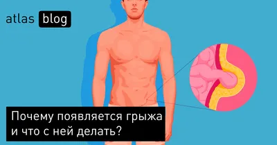 Паховые грыжи | Darecchio Surgery