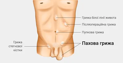 Паховая грыжа у мужчин и женщин: симптомы, диагностика, лечение