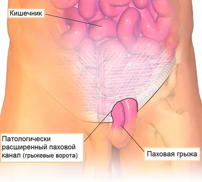 Почему возникает грыжа и как ее вылечить?